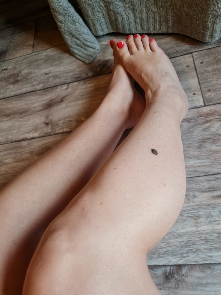 Mitt melanom (stadie 3)